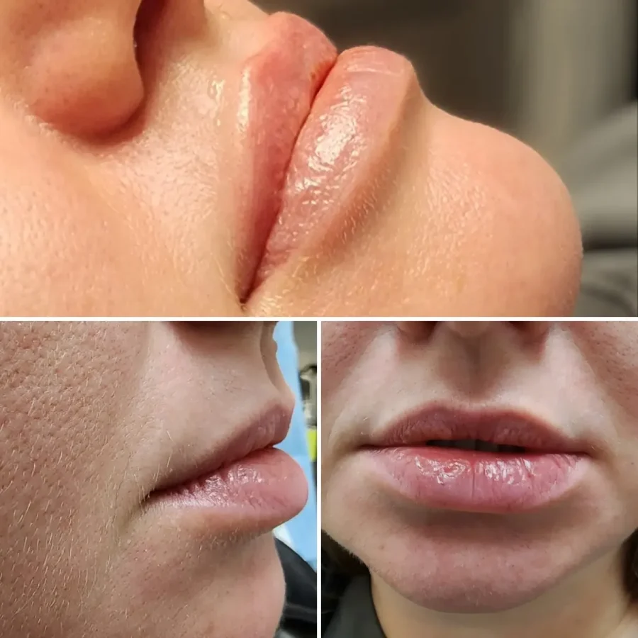 Naked-SKN-Aesthetics-Dermal-Fillers-gallery-b-in-The-Woodlands-TX