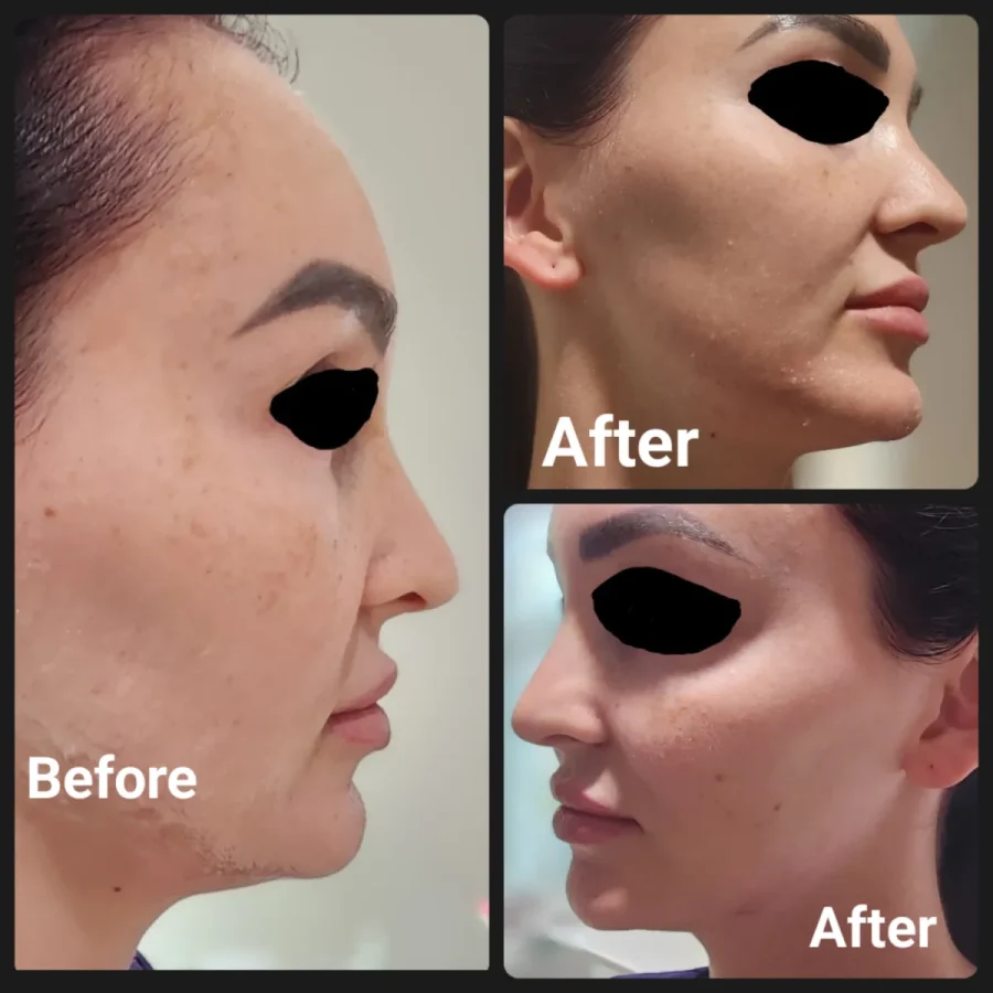 Naked-SKN-Aesthetics-Dermal-Fillers-gallery-g-in-The-Woodlands-TX