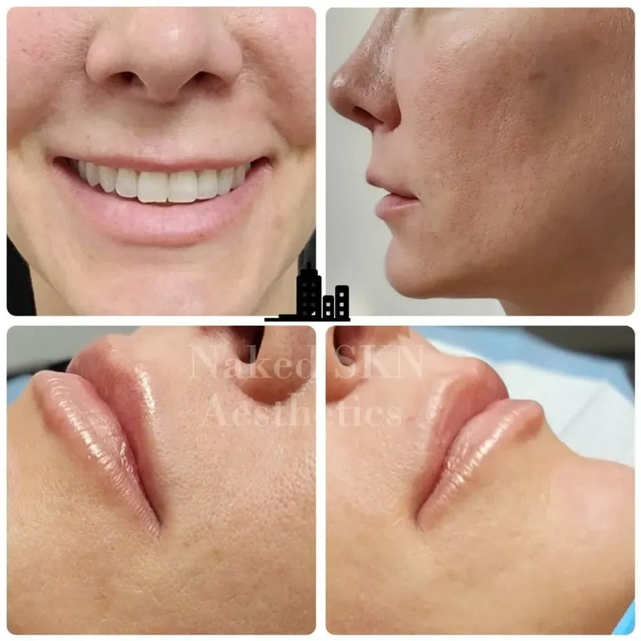 Naked-SKN-Aesthetics-Dermal-Fillers-gallery-h-in-The-Woodlands-TX