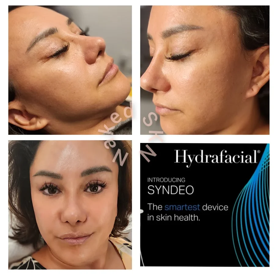 Naked-SKN-Aesthetics-Hydrafacial-gallery-a-in-The-Woodlands-TX