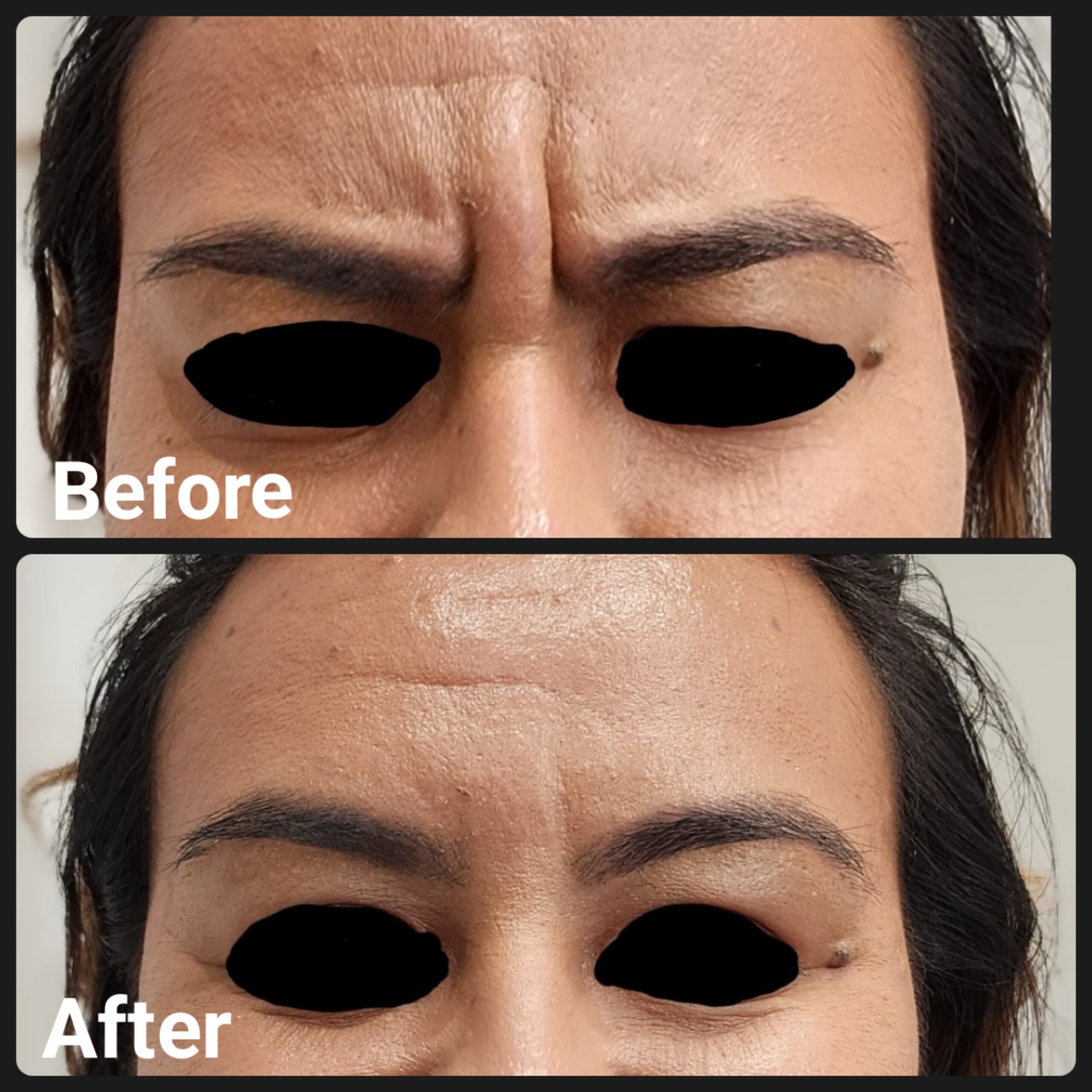 Before and After Cosmetic Injectables Gallery