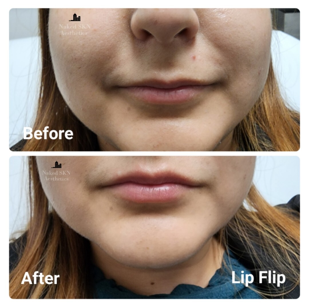 Before and After Cosmetic Injectables Gallery